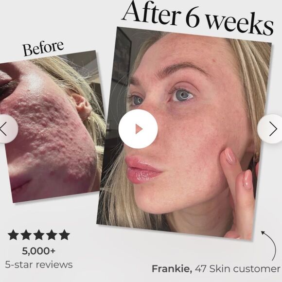 47 Skin Silver Mask, Anti-Blemish and Scar Repair w/Silver Chitoderm, 2 fl oz. - Picture 6 of 16